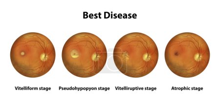 Foto de Etapas de la mejor enfermedad, vista oftalmoscópica, ilustración científica - Imagen libre de derechos