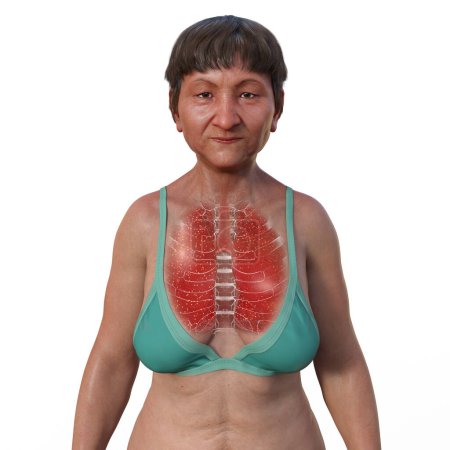 Téléchargez les photos : Illustration photoréaliste 3D de la moitié supérieure d'une femme à la peau transparente, mettant en valeur les poumons atteints de tuberculose miliaire. - en image libre de droit
