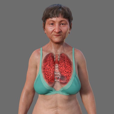 Téléchargez les photos : Illustration médicale 3D photoréaliste de la moitié supérieure d'une patiente à peau transparente, révélant l'état des poumons du fumeur - en image libre de droit