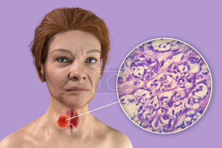 Foto de Una ilustración científica en 3D que muestra a una mujer con piel transparente, revelando un tumor en su glándula tiroides, junto con una imagen micrográfica del carcinoma folicular tiroideo. - Imagen libre de derechos