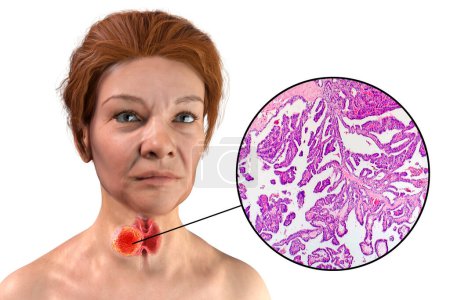 Foto de Una ilustración científica en 3D que muestra a una mujer con piel transparente, revelando un tumor en su glándula tiroides, junto con una imagen micrográfica del carcinoma papilar de tiroides. - Imagen libre de derechos