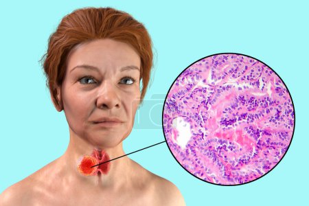Photo for A 3D scientific illustration showcasing a woman with transparent skin, revealing a tumor in her thyroid gland, along with a micrograph image of papillary thyroid carcinoma. - Royalty Free Image