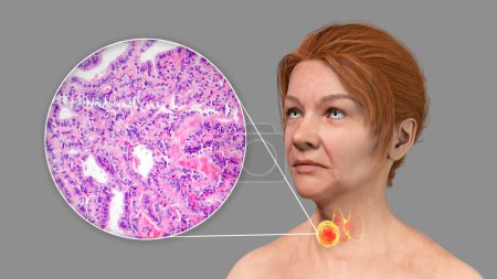 Foto de Una ilustración científica en 3D que muestra a una mujer con piel transparente, revelando un tumor en su glándula tiroides, junto con una imagen micrográfica del carcinoma papilar de tiroides. - Imagen libre de derechos