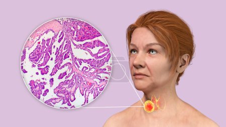 Téléchargez les photos : Une illustration scientifique 3D montrant une femme à la peau transparente, révélant une tumeur dans sa glande thyroïde, ainsi qu'une image micrographique du carcinome thyroïdien papillaire. - en image libre de droit