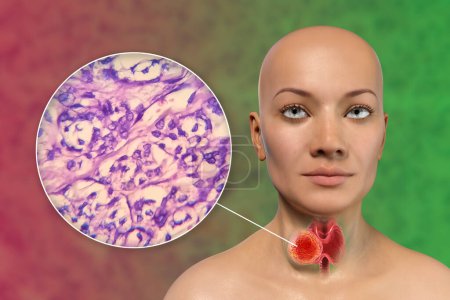 Foto de Una ilustración científica en 3D que muestra a una mujer con piel transparente, revelando un tumor en su glándula tiroides, junto con una imagen micrográfica del carcinoma folicular tiroideo. - Imagen libre de derechos