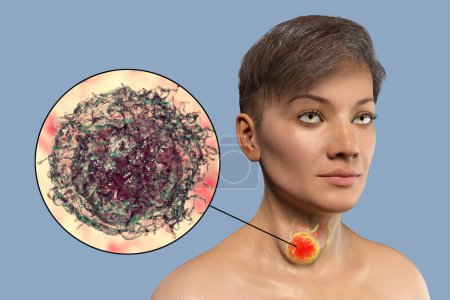 Foto de Una ilustración 3D de una mujer con cáncer de tiroides, con piel transparente que revela un tumor en su glándula tiroides. Una vista de cerca muestra la estructura detallada de las células cancerosas de tiroides. - Imagen libre de derechos
