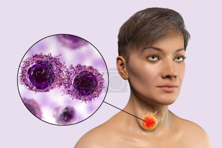 Foto de Una ilustración 3D de una mujer con cáncer de tiroides, con piel transparente que revela un tumor en su glándula tiroides. Una vista de cerca muestra la estructura detallada de las células cancerosas de tiroides. - Imagen libre de derechos