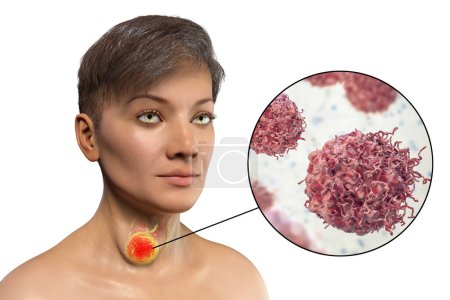 Photo for A 3D illustration of a woman with thyroid cancer, featuring transparent skin that reveals a tumor in her thyroid gland. A close-up view showcases the detailed structure of thyroid cancer cells. - Royalty Free Image