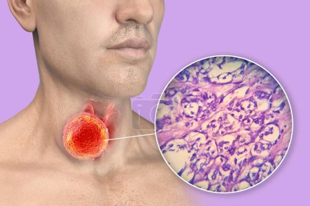 Téléchargez les photos : Une illustration scientifique 3D montrant un homme à la peau transparente, révélant une tumeur dans sa glande thyroïde, ainsi qu'une image micrographique du carcinome folliculaire thyroïdien. - en image libre de droit