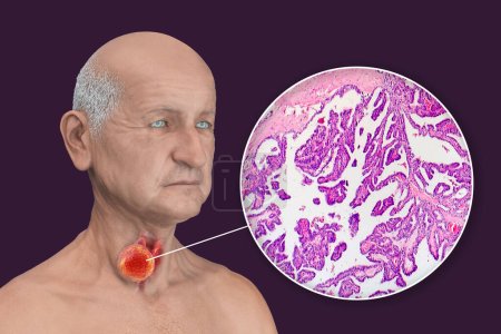 Photo for A 3D scientific illustration showcasing a man with transparent skin, revealing a tumor in his thyroid gland, along with a micrograph image of papillary thyroid carcinoma. - Royalty Free Image