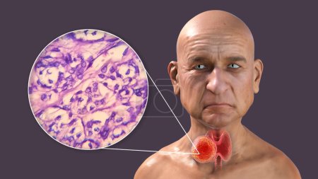 Téléchargez les photos : Une illustration scientifique 3D montrant un homme à la peau transparente, révélant une tumeur dans sa glande thyroïde, ainsi qu'une image micrographique du carcinome folliculaire thyroïdien. - en image libre de droit