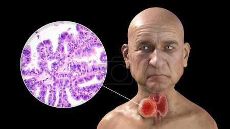 Téléchargez les photos : Une illustration scientifique 3D montrant un homme à la peau transparente, révélant une tumeur dans sa glande thyroïde, ainsi qu'une image micrographique du carcinome thyroïdien papillaire. - en image libre de droit