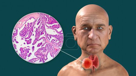 Foto de Una ilustración científica en 3D que muestra a un hombre con piel transparente, revelando un tumor en su glándula tiroides, junto con una imagen micrográfica del carcinoma papilar de tiroides. - Imagen libre de derechos