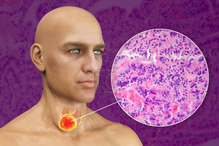 Foto de Una ilustración científica en 3D que muestra a un hombre con piel transparente, revelando un tumor en su glándula tiroides, junto con una imagen micrográfica del carcinoma papilar de tiroides. - Imagen libre de derechos