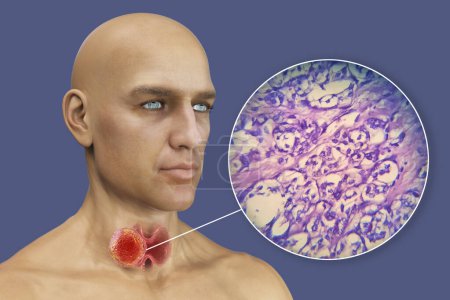 Foto de Una ilustración científica en 3D que muestra a un hombre con piel transparente, revelando un tumor en su glándula tiroides, junto con una imagen micrográfica del carcinoma folicular tiroideo. - Imagen libre de derechos