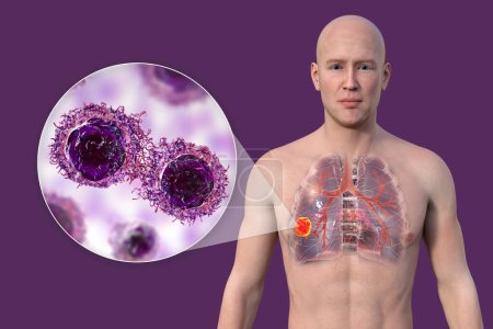 Téléchargez les photos : Illustration photoréaliste 3D de la moitié supérieure d'un homme à la peau transparente, révélant la présence d'un cancer du poumon, et vue rapprochée des cellules cancéreuses. - en image libre de droit