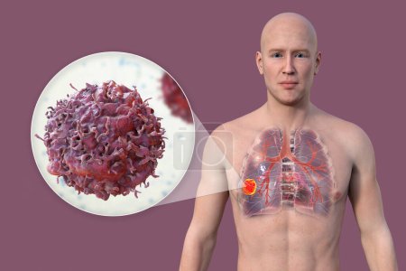 Foto de Una ilustración fotorrealista en 3D de la mitad superior de un hombre con piel transparente, que revela la presencia de cáncer de pulmón y la visión cercana de las células cancerosas. - Imagen libre de derechos