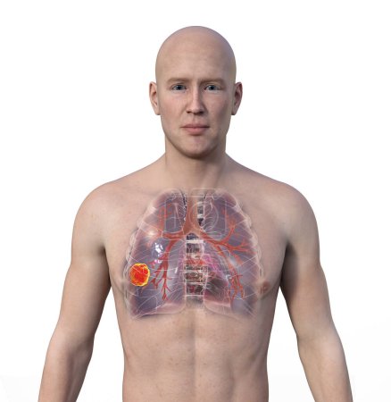 Foto de Una ilustración fotorrealista 3D de la mitad superior de un hombre con piel transparente, revelando la presencia de cáncer de pulmón. - Imagen libre de derechos