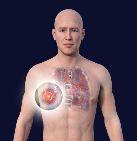Foto de Una ilustración fotorrealista 3D de la mitad superior de un hombre con piel transparente, revelando la presencia de cáncer de pulmón. - Imagen libre de derechos