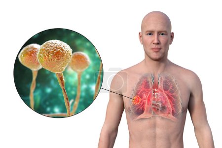 Téléchargez les photos : Illustration photoréaliste en 3D de la moitié supérieure d'un homme à peau transparente, révélant une lésion de mucormycose pulmonaire, avec vue rapprochée des champignons Mucor - en image libre de droit