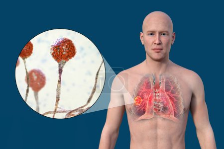 Foto de Una ilustración fotorrealista 3D de la mitad superior de un hombre con piel transparente, revelando una lesión de mucormicosis pulmonar, con vista cercana de los hongos Mucor - Imagen libre de derechos