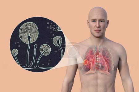 Téléchargez les photos : Illustration photoréaliste en 3D de la moitié supérieure d'un homme à peau transparente, révélant une lésion de mucormycose pulmonaire, avec vue rapprochée des champignons Mucor - en image libre de droit