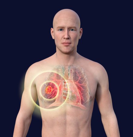 Foto de Una ilustración fotorrealista 3D de la mitad superior de un hombre con piel transparente, revelando una lesión de mucormicosis pulmonar. - Imagen libre de derechos