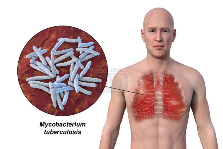 Photo for A 3D illustration showcasing the upper half part of a man with transparent skin, revealing the lungs affected by miliary tuberculosis, and close-up view of Mycobacterium tuberculosis bacteria. - Royalty Free Image