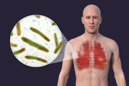 Foto de Una ilustración en 3D que muestra la mitad superior de un hombre con la piel transparente, revelando los pulmones afectados por la tuberculosis miliar, y la vista de cerca de la bacteria Mycobacterium tuberculosis. - Imagen libre de derechos