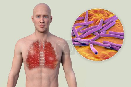 Téléchargez les photos : Illustration 3D montrant la moitié supérieure d'un homme à peau transparente, révélant les poumons affectés par la tuberculose miliaire, et vue rapprochée de la bactérie Mycobacterium tuberculosis. - en image libre de droit