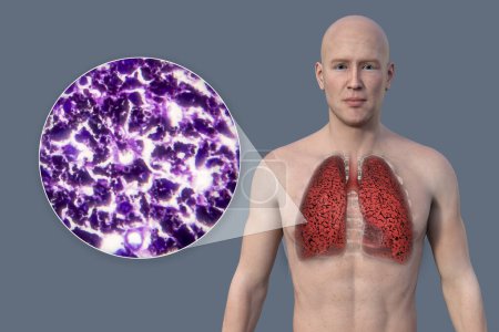Téléchargez les photos : Illustration 3D de la moitié supérieure d'un homme à la peau transparente, révélant l'état des poumons du fumeur, ainsi qu'une image micrographique des poumons affectés par le tabagisme. - en image libre de droit