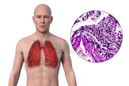 Téléchargez les photos : Illustration 3D de la moitié supérieure d'un homme à la peau transparente, révélant l'état des poumons du fumeur, ainsi qu'une image micrographique des poumons affectés par le tabagisme. - en image libre de droit