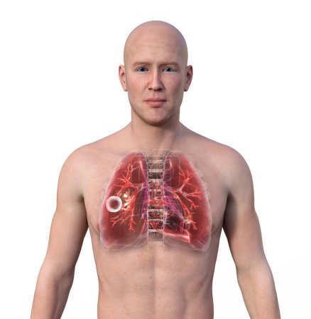 Foto de Una ilustración fotorrealista en 3D de la mitad superior de un hombre con piel transparente, mostrando los pulmones afectados por la tuberculosis cavernosa. - Imagen libre de derechos