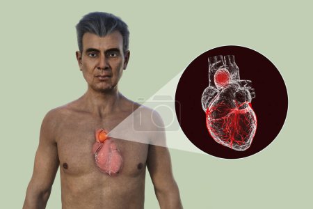 Téléchargez les photos : Illustration photoréaliste 3D de la moitié supérieure d'un homme âgé à la peau transparente, révélant un anévrisme aortique ascendant. - en image libre de droit