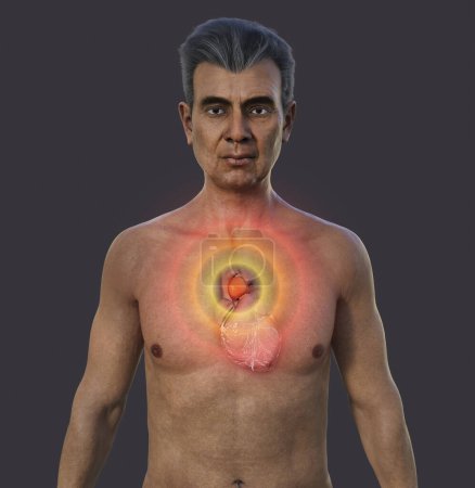 Photo for A 3D photorealistic illustration of the upper half part of a senior man with transparent skin, revealing an ascending aortic aneurysm. - Royalty Free Image