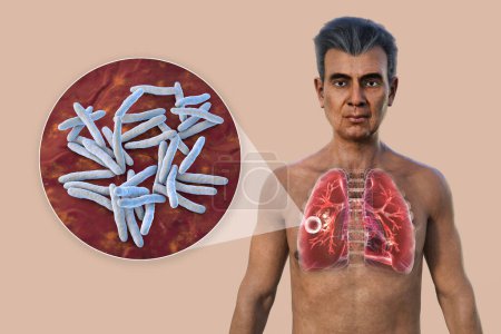 Foto de Una ilustración fotorrealista 3D de la mitad superior de un hombre con la piel transparente, mostrando los pulmones afectados por la tuberculosis cavernosa, y vista de cerca de la bacteria Mycobacterium tuberculosis. - Imagen libre de derechos