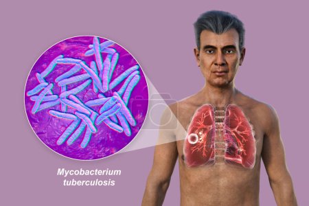 Foto de Una ilustración fotorrealista 3D de la mitad superior de un hombre con la piel transparente, mostrando los pulmones afectados por la tuberculosis cavernosa, y vista de cerca de la bacteria Mycobacterium tuberculosis. - Imagen libre de derechos