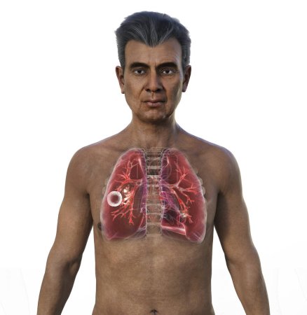 Foto de Una ilustración fotorrealista en 3D de la mitad superior de un hombre con piel transparente, mostrando los pulmones afectados por la tuberculosis cavernosa. - Imagen libre de derechos