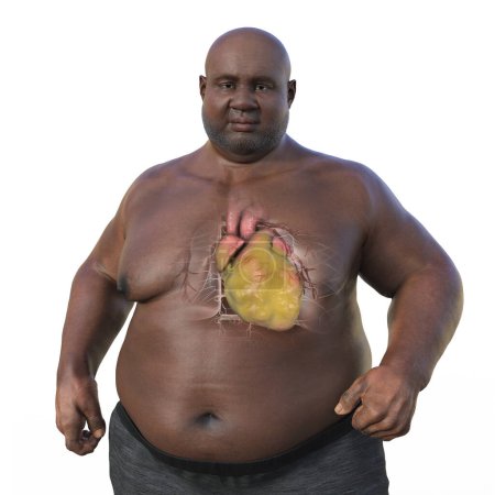 Foto de Una ilustración médica en 3D de un hombre mayor con sobrepeso y piel transparente, mostrando un corazón agrandado y obeso. - Imagen libre de derechos