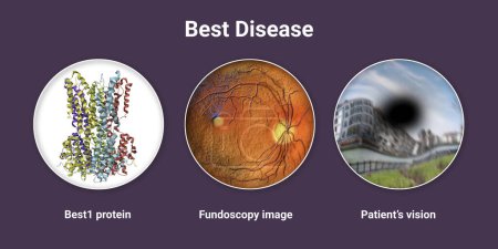 Photo for Best disease. Best vitelliform macular dystrophy, 3D illustration showing Best1 protein, classic fundoscopic egg-yolk lesion on retina, and distorted vision with black spot in a patient - Royalty Free Image
