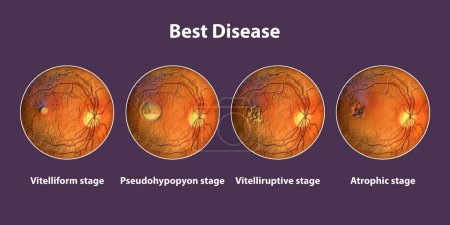 Photo for Stages of Best disease, ophthalmoscope view, scientific 3D illustration - Royalty Free Image