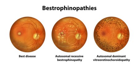 Photo for Bestrophinopathies, inherited retinal disorders caused by mutations in the BEST1 gene, illustration. Best disease, autosomal recessive bestrophinopathy, autosomal dominant vitreoretinochoroidopathy - Royalty Free Image
