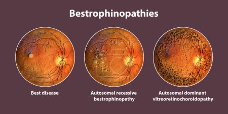 Photo for Bestrophinopathies, inherited retinal disorders caused by mutations in the BEST1 gene, 3D render. Best disease, autosomal recessive bestrophinopathy, and autosomal dominant vitreoretinochoroidopathy - Royalty Free Image