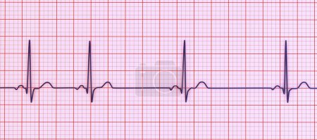 Illustration 3D détaillée d'un électrocardiogramme ECG présentant une arythmie sinusale, une condition caractérisée par des rythmes cardiaques irréguliers provenant du n?ud sinusal.