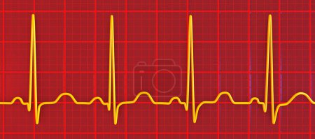 Foto de Una ilustración 3D detallada de un electrocardiograma ECG que muestra taquicardia sinusal, un ritmo cardíaco regular con frecuencia cardíaca que es superior al límite superior de la normalidad de 90-100 lpm en adultos. - Imagen libre de derechos