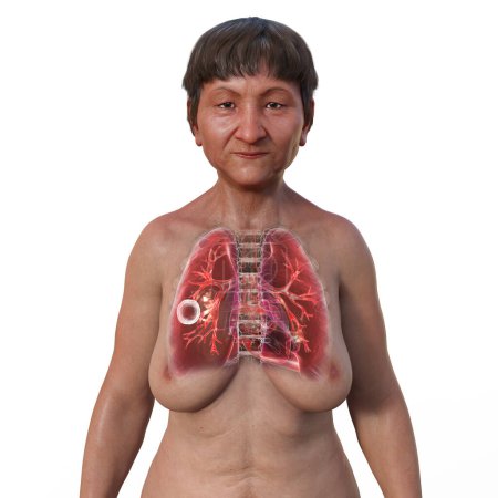 Foto de Una ilustración fotorrealista en 3D de la mitad superior de una paciente con piel transparente, mostrando los pulmones afectados por la tuberculosis cavernosa. - Imagen libre de derechos