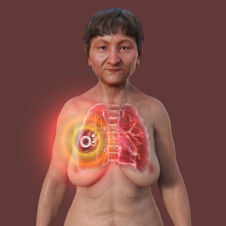 Foto de Una ilustración fotorrealista en 3D de la mitad superior de una paciente con piel transparente, mostrando los pulmones afectados por la tuberculosis cavernosa. - Imagen libre de derechos