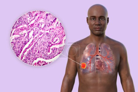 Foto de Una ilustración fotorrealista en 3D de la mitad superior de un hombre africano con piel transparente, que revela la presencia de cáncer de pulmón, junto con una imagen micrográfica del adenocarcinoma de pulmón - Imagen libre de derechos