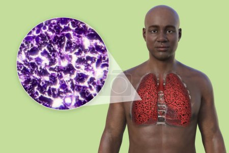 Photo for A 3D photorealistic illustration of the upper half part of an African man with transparent skin, revealing the condition of smoker's lungs, along with a micrograph image of lungs affected by smoking. - Royalty Free Image