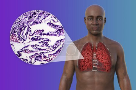 Foto de Una ilustración fotorrealista en 3D de la mitad superior de un hombre africano con piel transparente, que revela la condición de los pulmones del fumador, junto con una imagen micrográfica de los pulmones afectados por el tabaquismo.. - Imagen libre de derechos